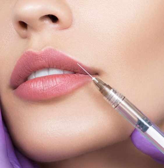 Lip Filler Injection treatment in Dubai