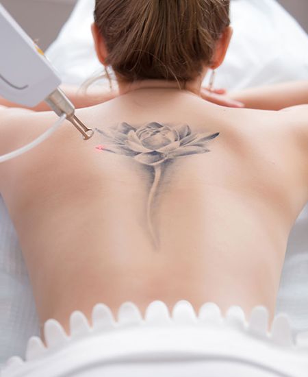 Laser Tattoo Removal treatment in Dubai