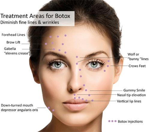 Where botox is injected ?