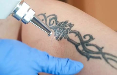 How To Remove Permanent Tattoos 4 Surgical Methods And 6 DIYs