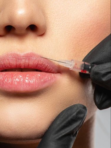 lip fillers injection lip filler injection lip filler near me